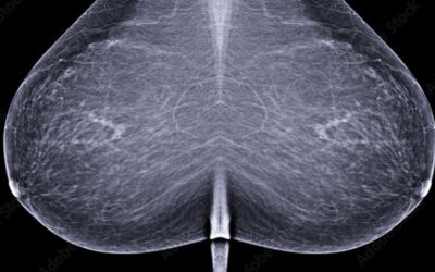 Tout savoir sur la mammographie de dépistage du cancer du sein